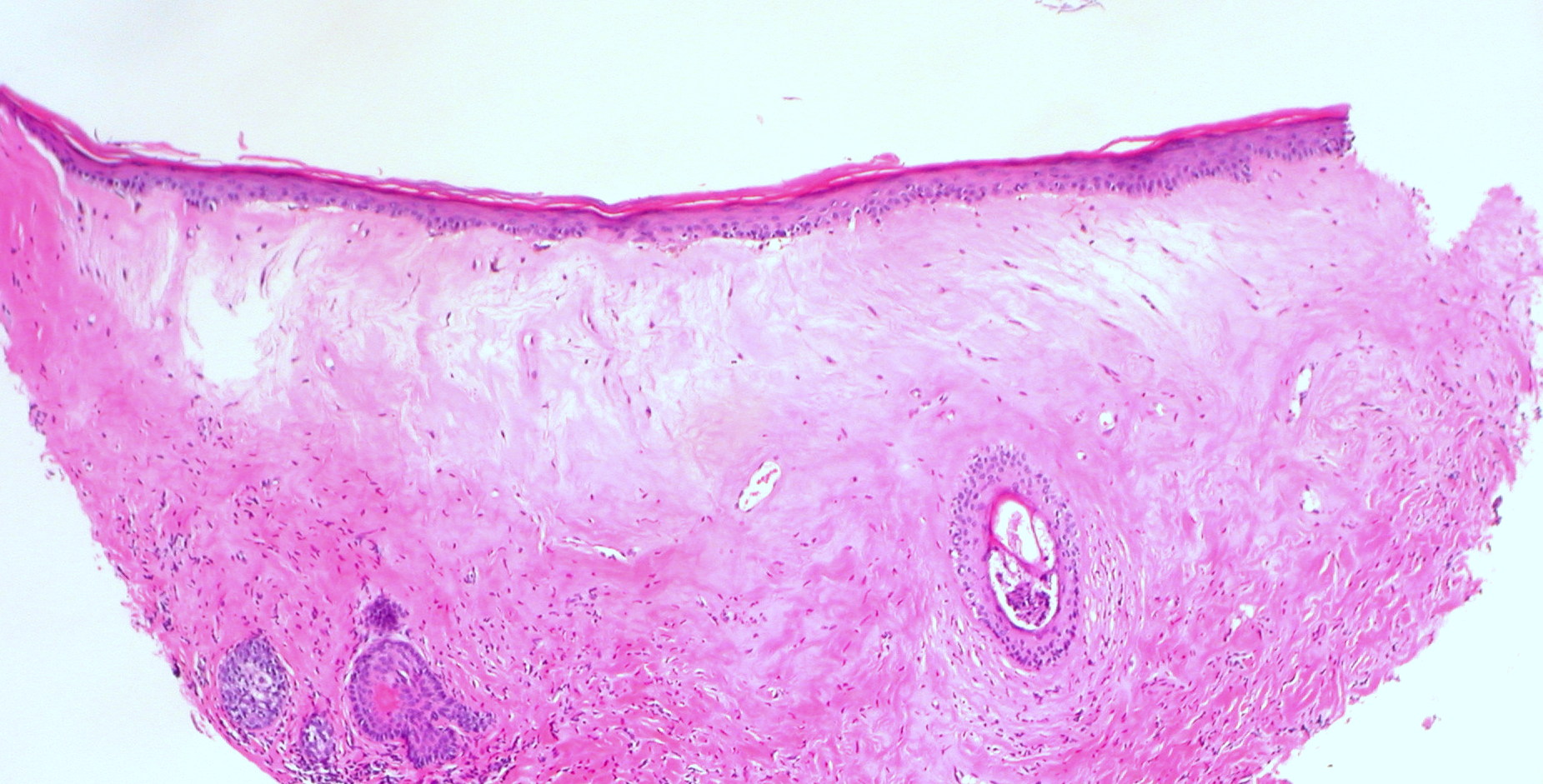Vulva lichen sclerosus Lichen Sclerosus