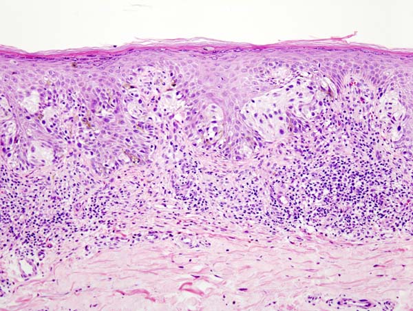 File:Malignant melanoma (2) at thigh Case 01.jpg