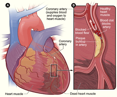 Most heart attacks occur due to plaque buildup in the arteries.