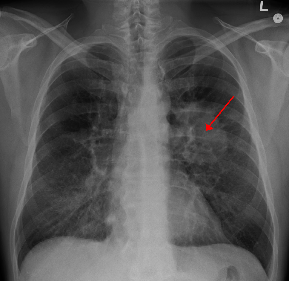 sarcoma cancer of the lungs