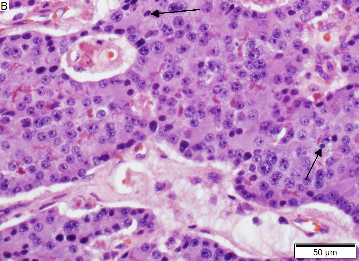 Low grade pancreatic neuroendocrine tumor