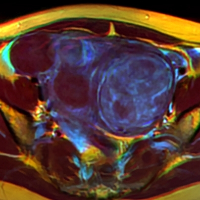 File:Pelvic MRI 05 fibroids.jpg