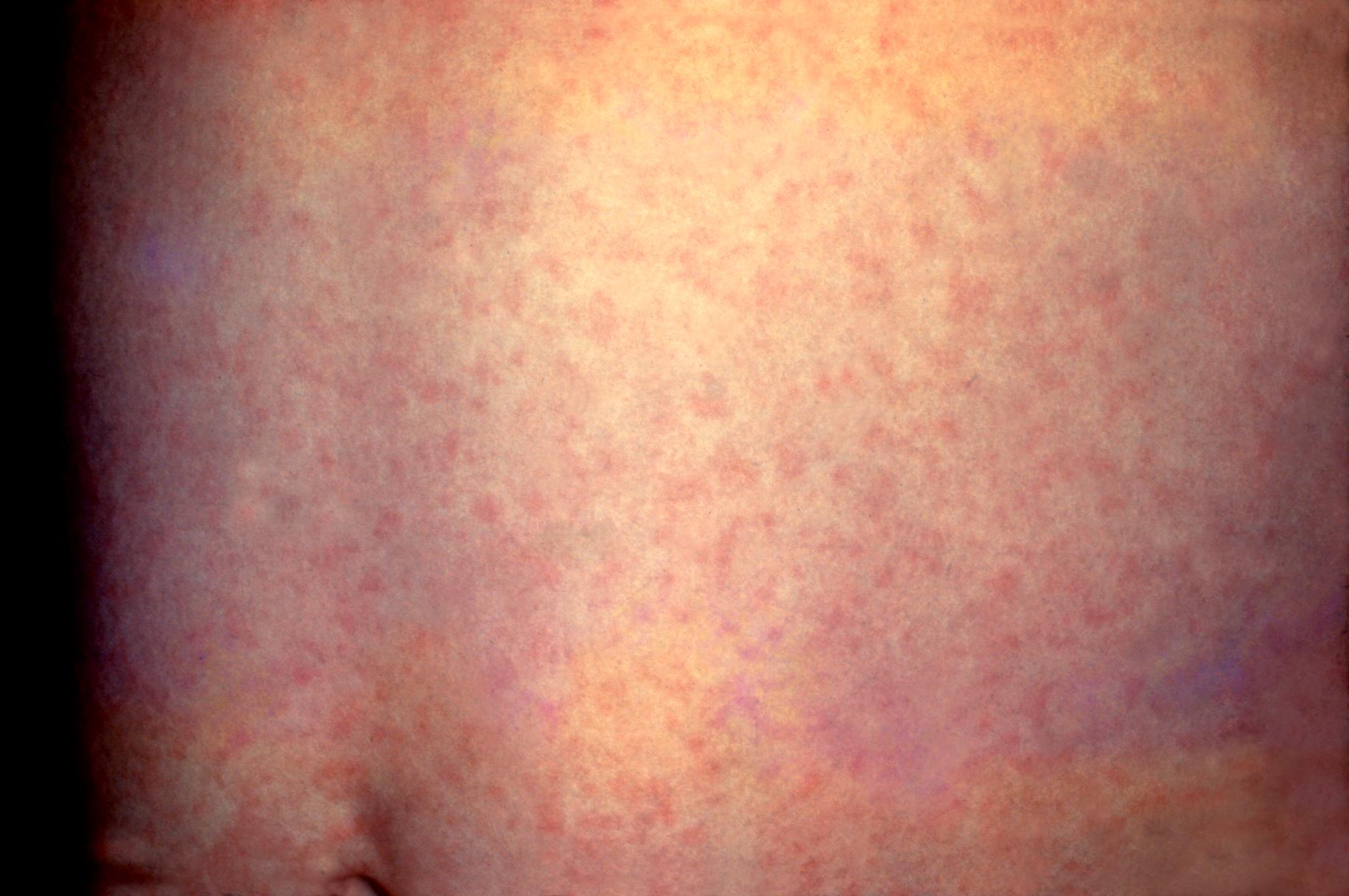 Hautausschlag hiv Skin rash