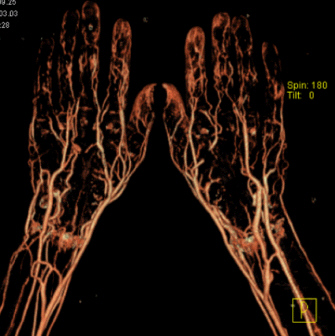 File:CT-Angiografie-Haende.jpg