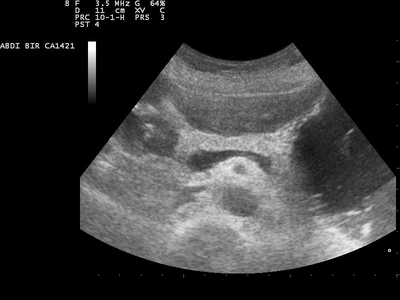 File:Ultrasound image of pancreas 110328111508 1115360.jpg