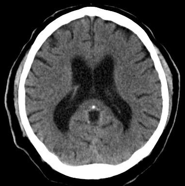 File:Morbus Fahr CT ax-08.jpg