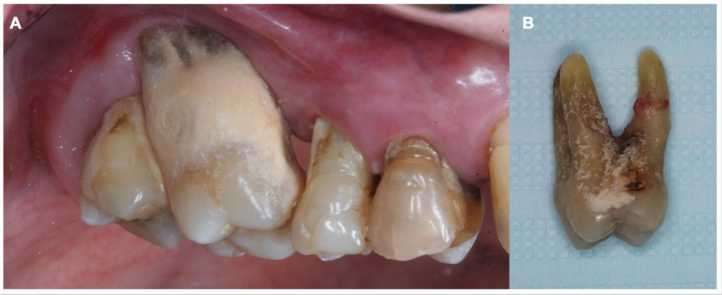 (A) Teeth from a chronic periodontal patient presented dental calculus, gingival recession and attachment loss. (B) Molar tooth showed in (A) extracted due to advanced periodontal disease involvement.