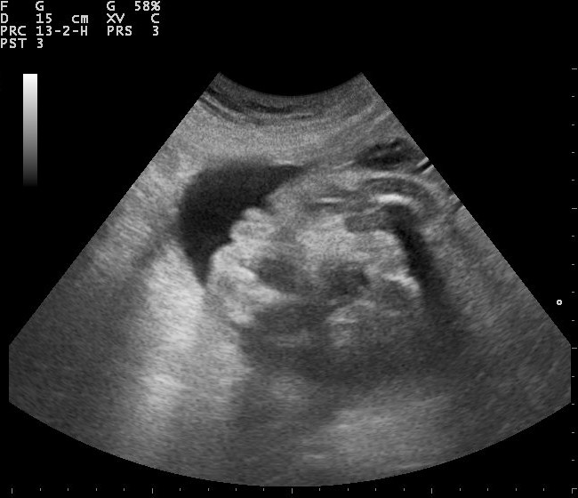 File:Pregnancy ultrasound 110324100756 1009360.jpg