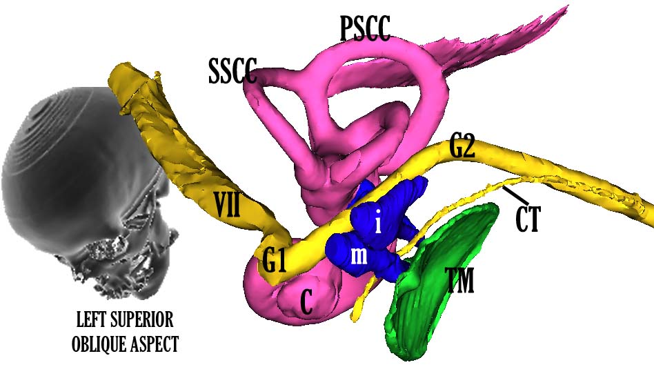 File:Mandibular nerve 3.jpg - Wikipedia