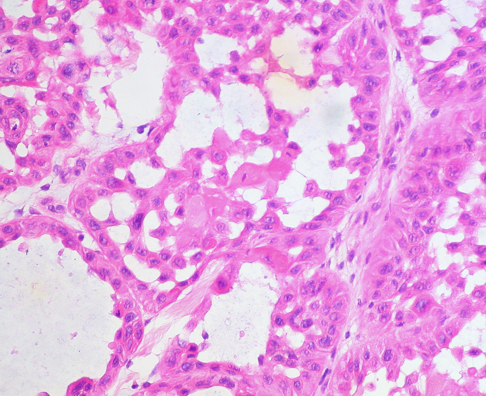 Squamous Cell carcinoma гистология