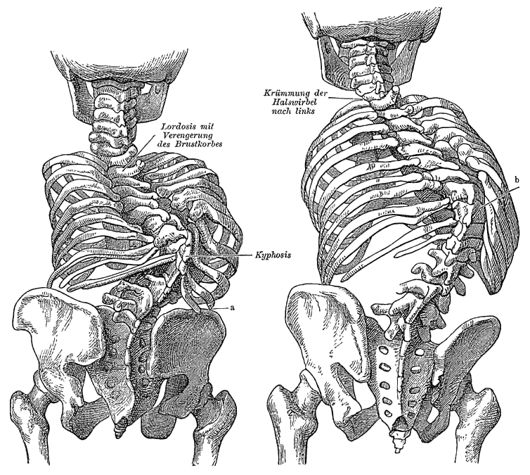Pattern of left flank pain from the thoracolumbar junction syndrome.