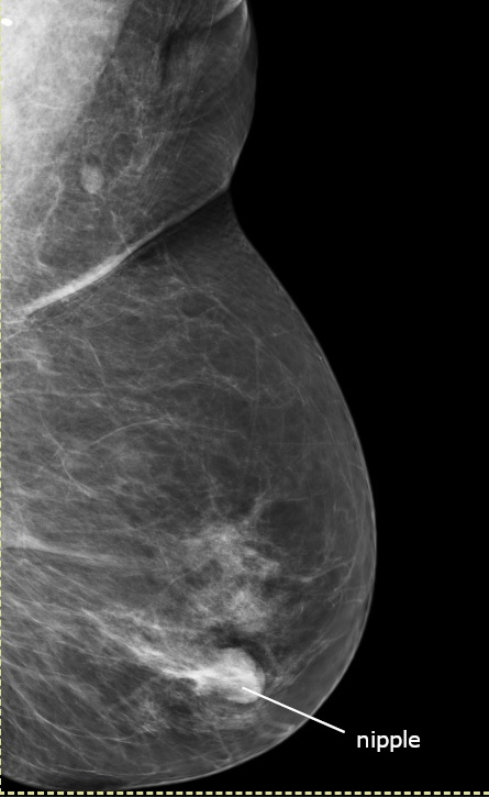 Mammography - Wikipedia