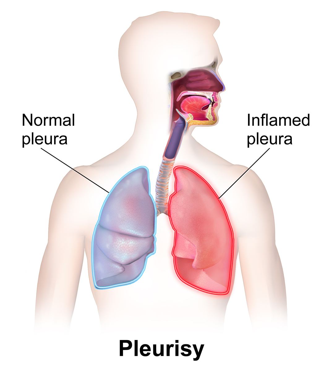 Pleurisy - Wikipedia