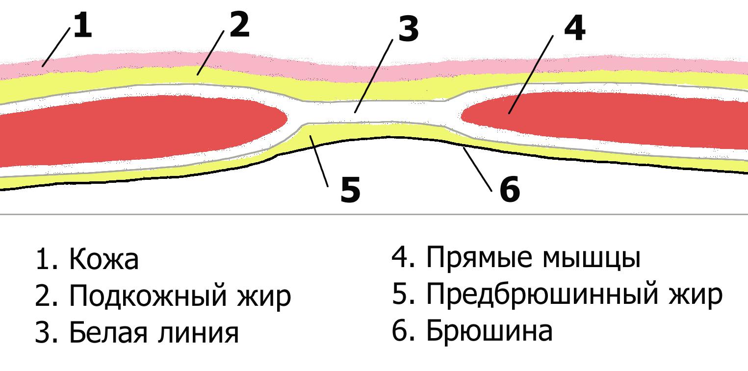 белая грыжа живота фото