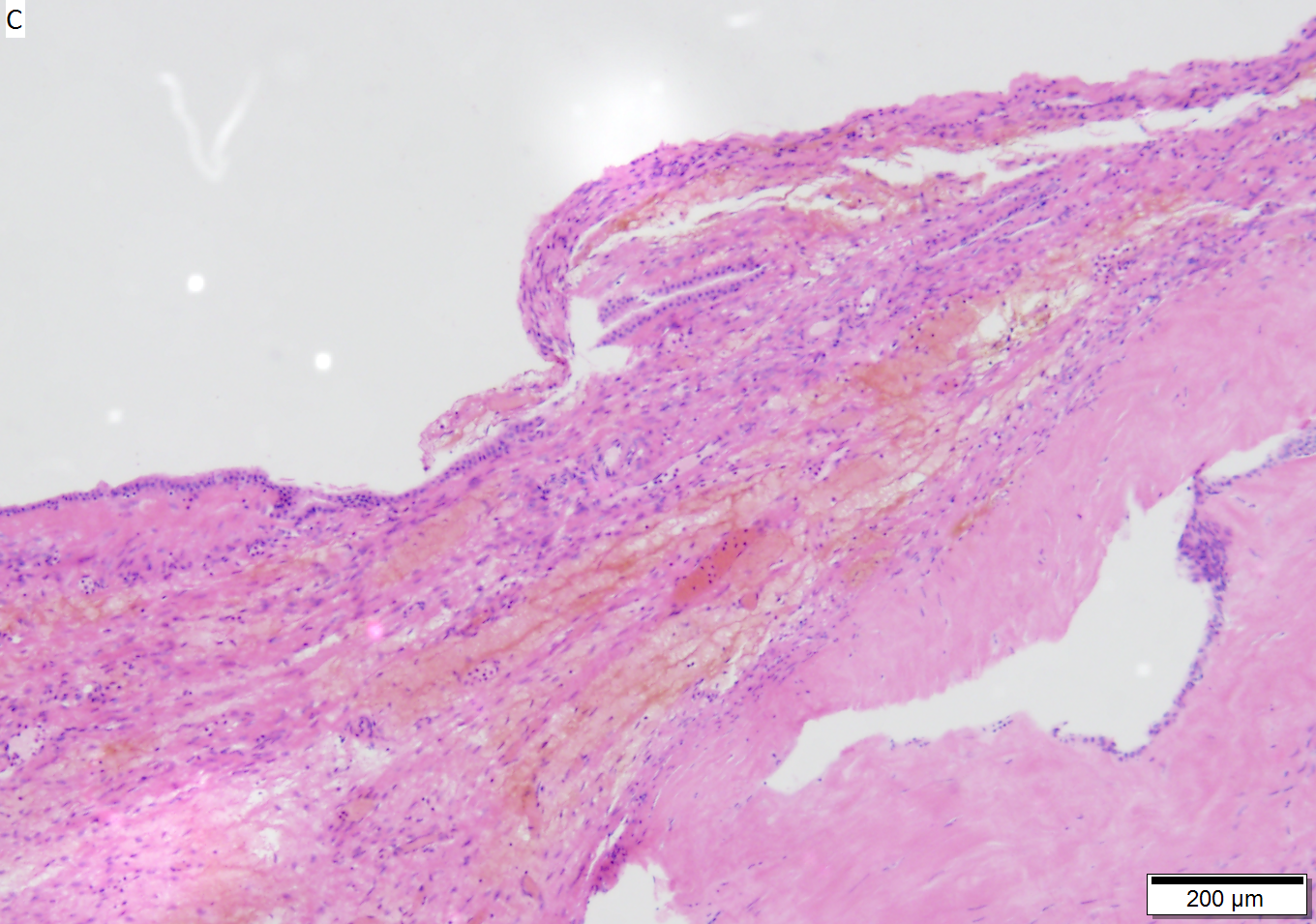 pancreatic pseudocyst histology