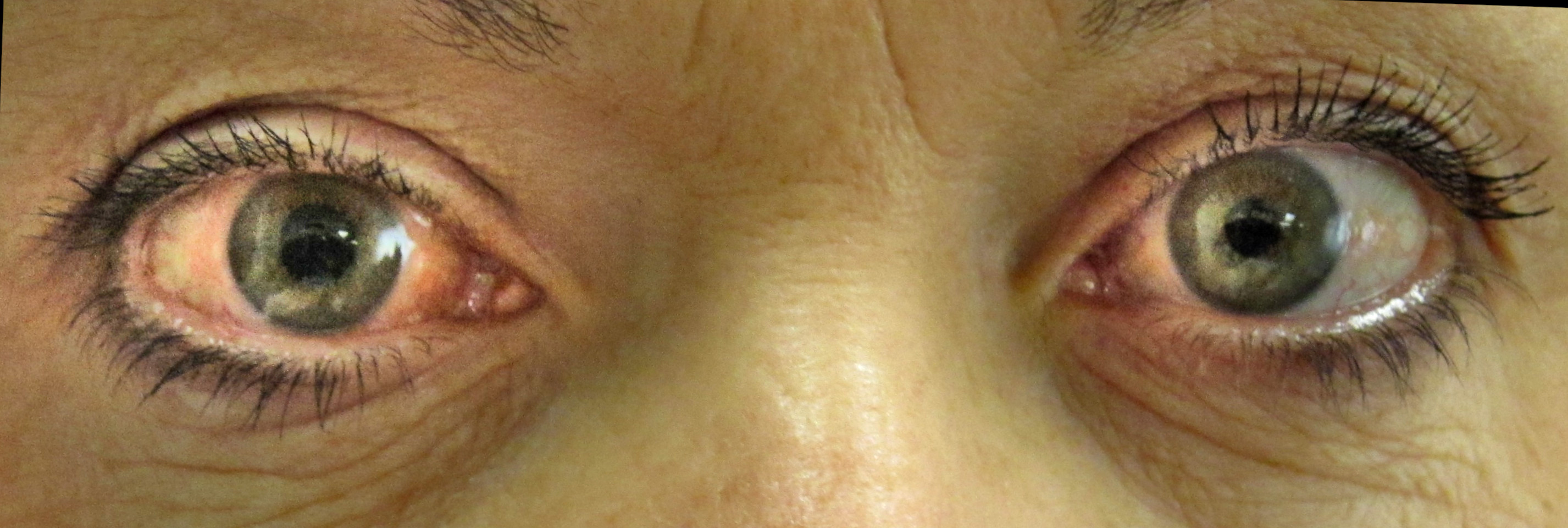 视网膜疾病检测