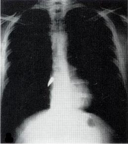 X-ray showing a bullet (white spot) in the heart