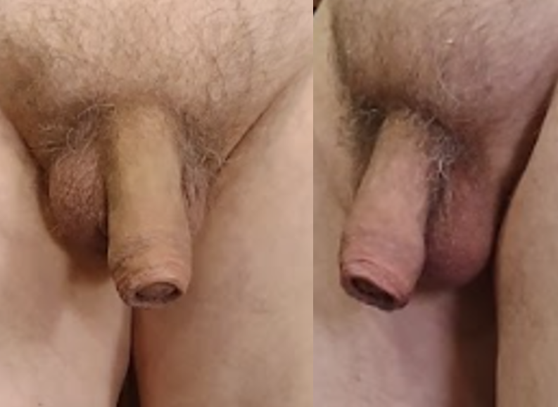 File:Forward and Right View of Foreskin Restoration.png