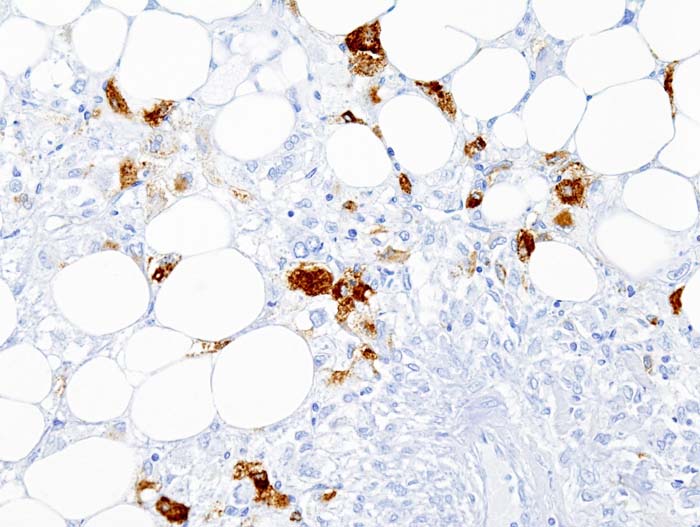 File:Renal angiomyolipoma (4) HMB-45 immunostain.JPG