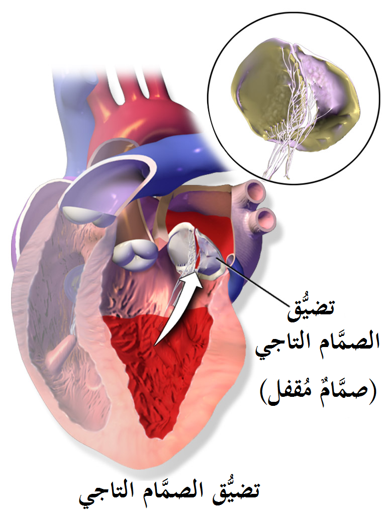 Mitral Valve Stenosis (MS)