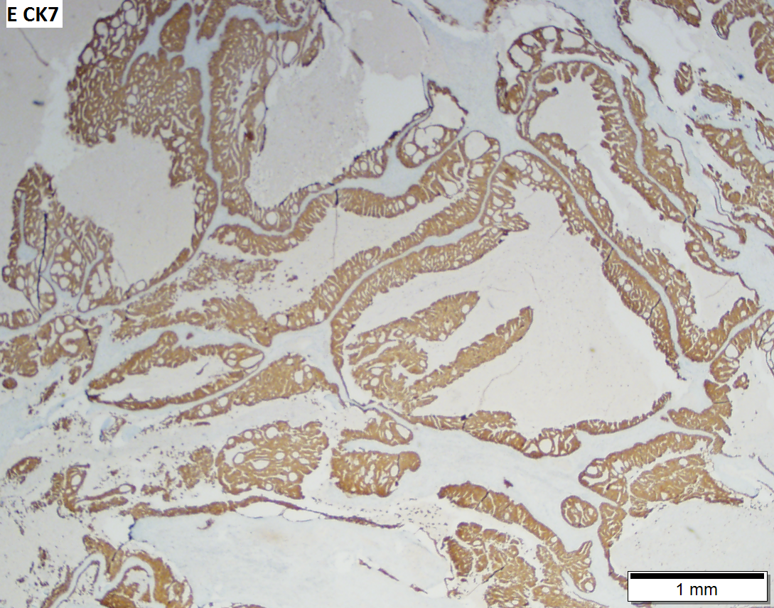 salivary duct carcinoma