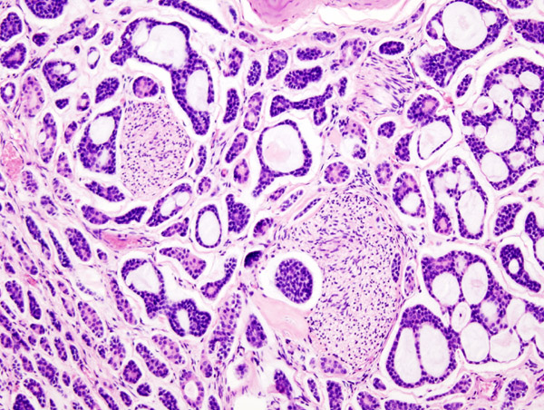 File:Adenoid cystic carcinoma (1).jpg