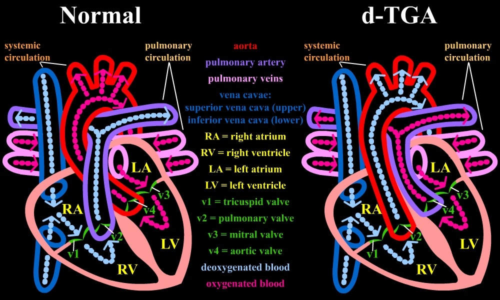 Transposition of the Great Arteries