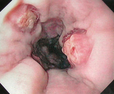 esophageal varices banding