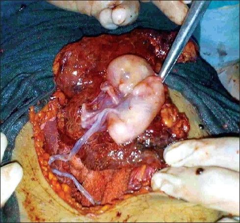 Solved During pregnancy, abdominal organs are moved out of