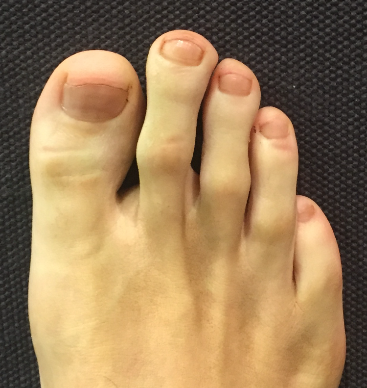 Morton's toe - Wikipedia