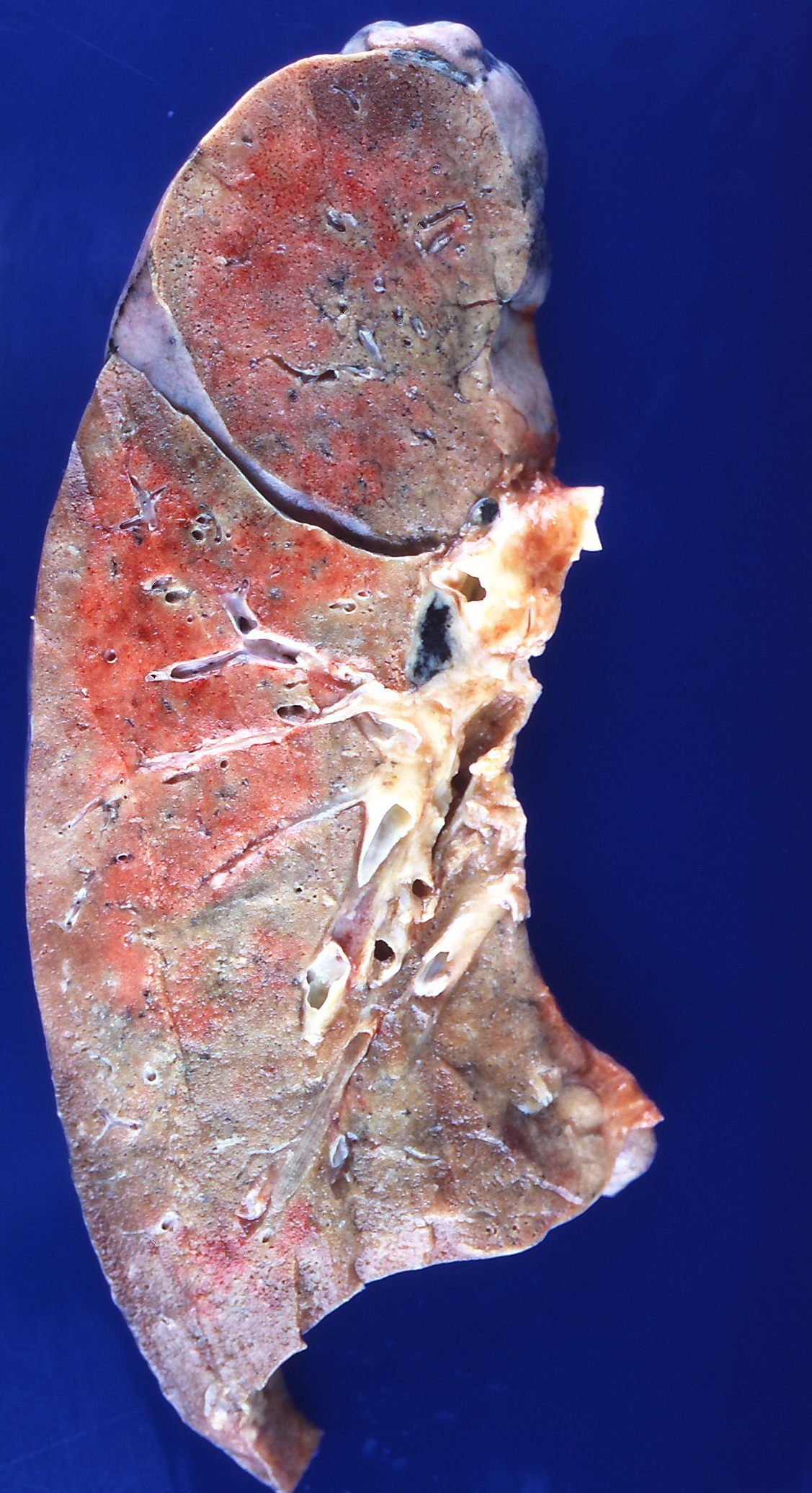 Radiation-induced lung injury - Wikipedia