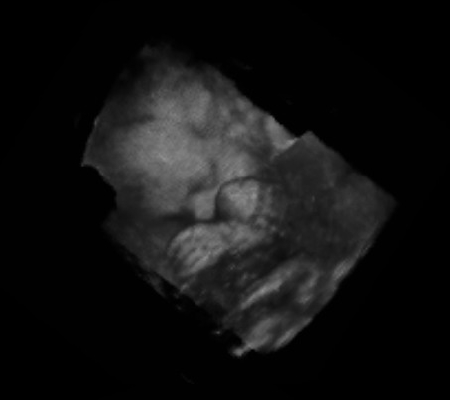 Fetal 3D-Sonography.jpg