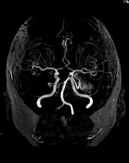 File:001-Arteriovenous-malformation-TOF-MIP-9.jpg