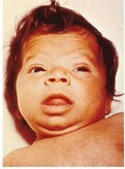 A 3-month-old infant with untreated congenital hypothyroidism showing myxedematous facies, a big tongue, and skin mottling