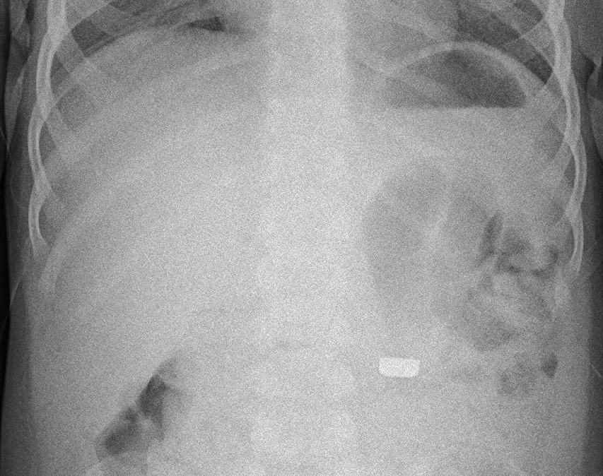 Retention of Bovie scratch pad radio-opaque marker during VATS Pleurodesis:  case report, Journal of Cardiothoracic Surgery