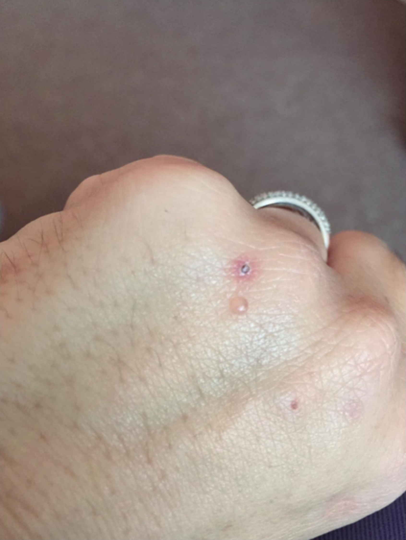 Vampire bite dermals