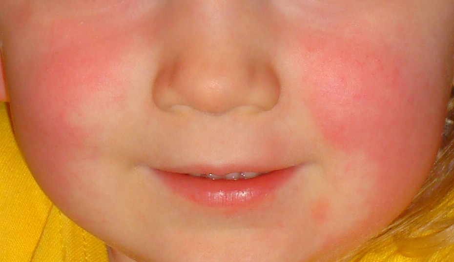 Scarlet Fever-Topic Overview - webmd.com