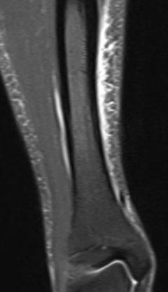 medial tibial stress syndrome bone scan