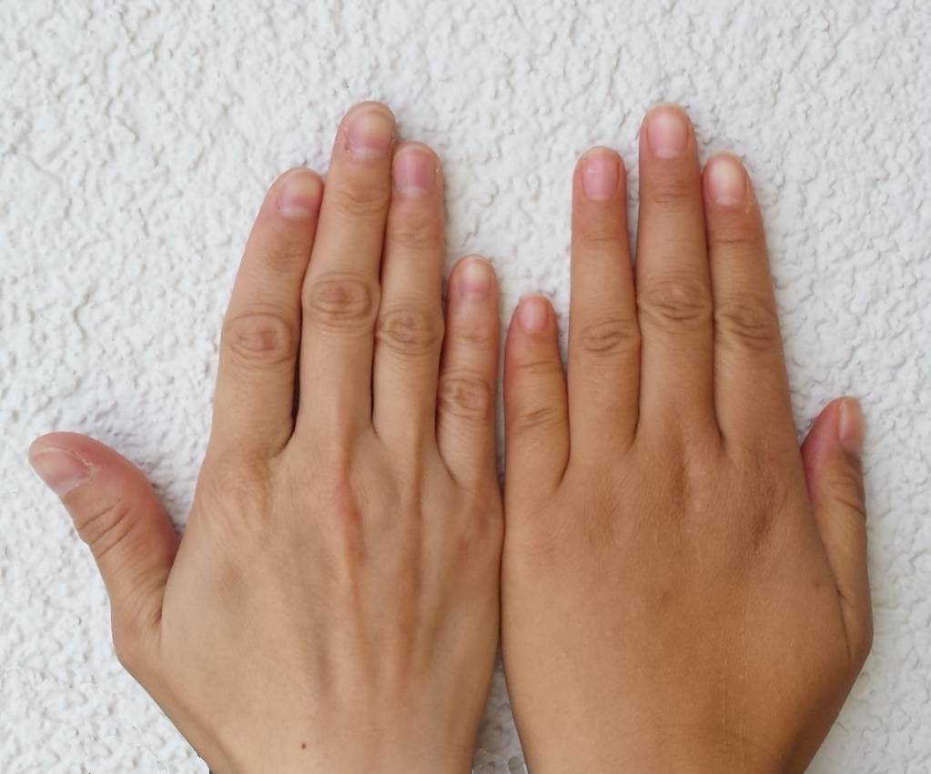 Брахидактилия большого пальца фото руки