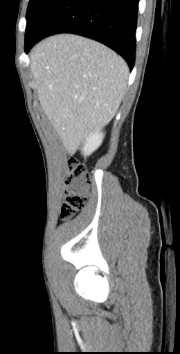 CT of a normal abdomen and pelvis, sagittal plane 40.png