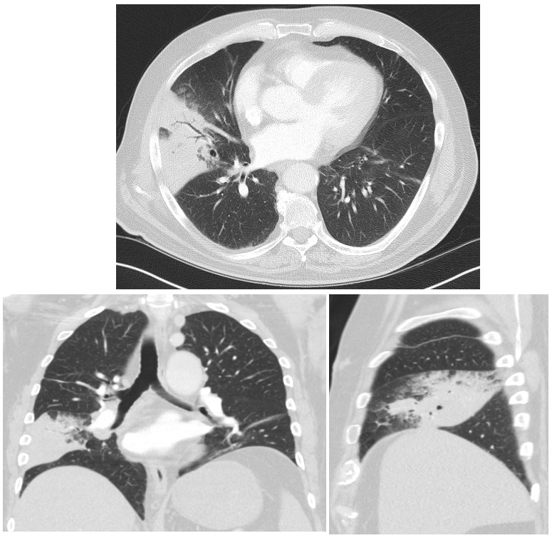 bronchopneumonia vs lobar pneumonia