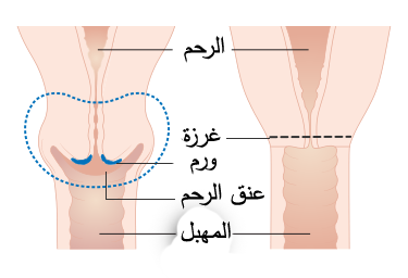 File:Diagram showing the parts removed with trachelectomy surgery CRUK 338-ar.png