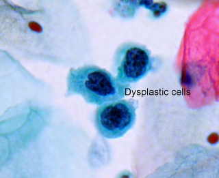 Dysplastic cells