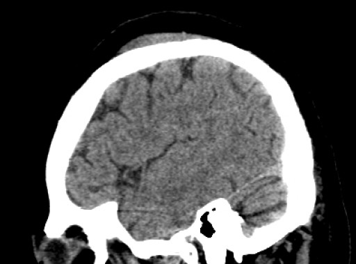 File:Morbus Fahr - CT - sagittal - 034.jpg