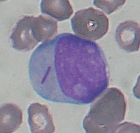 File:Myeloblast with Auer Rod smear 2009-11-23 cropped.jpg