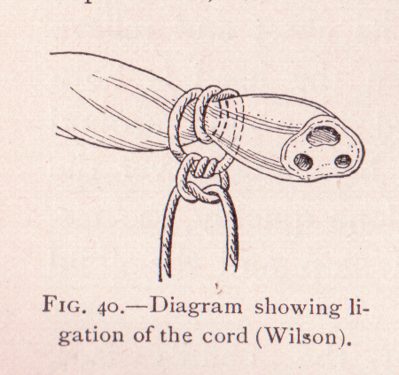 Information About Umbilical Cord Ties