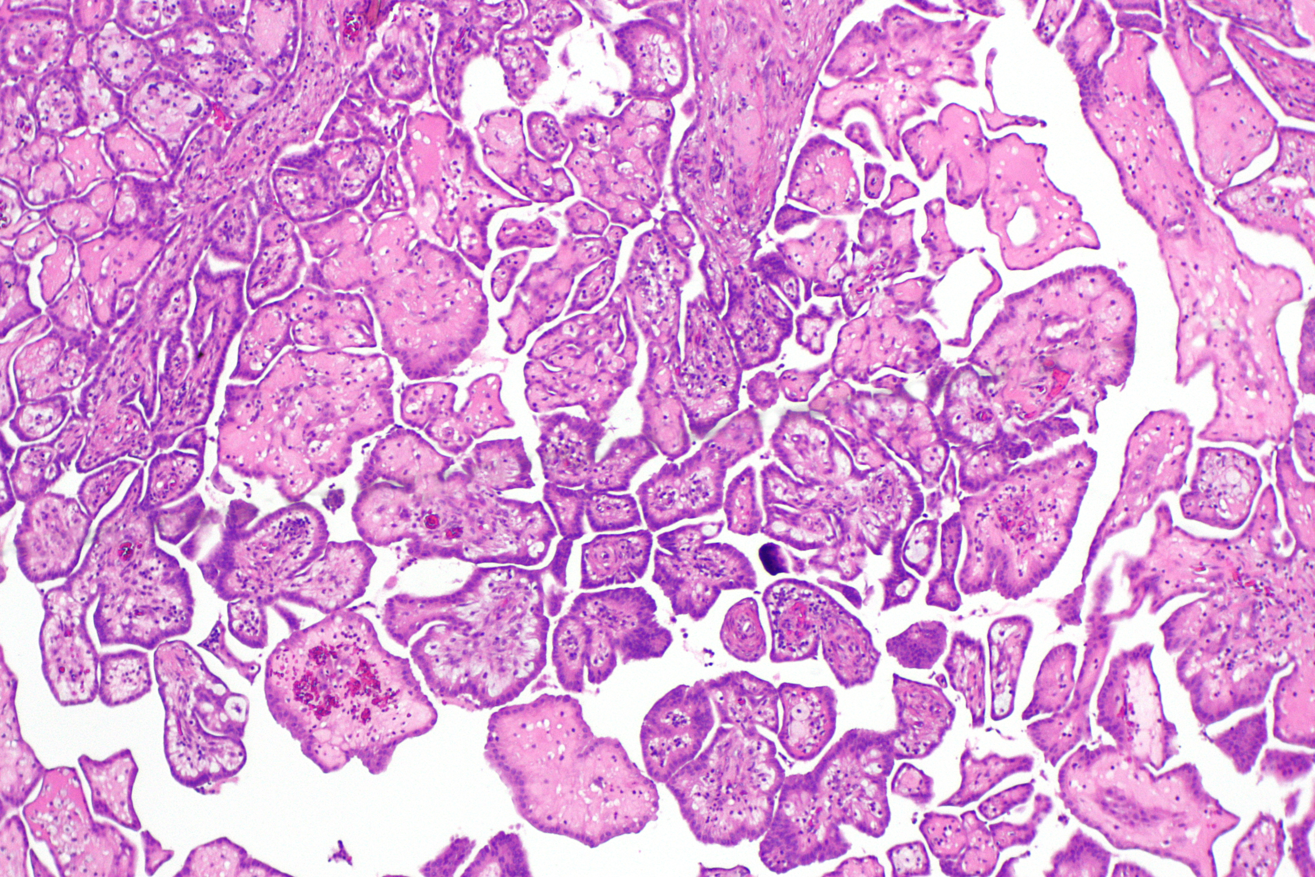 can prostate biopsy be false positive