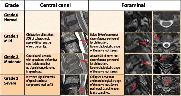 File:A grading system of intervertebral disk degeneration.webp