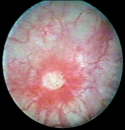 Thera-Seat, interstitial cystitis and pudendal nerve entrapment relief 