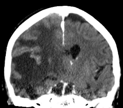 File:Keilbeinmeningeom mit Oedem - CT - coronar mit KM - 017.jpg